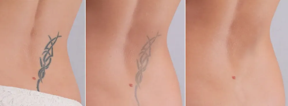 Odstraňovanie tetovania YAG laserom, ilustračné foto