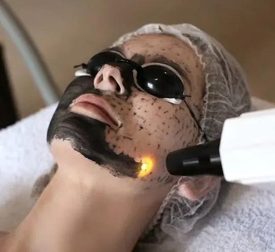 Karbónový peeling tváre